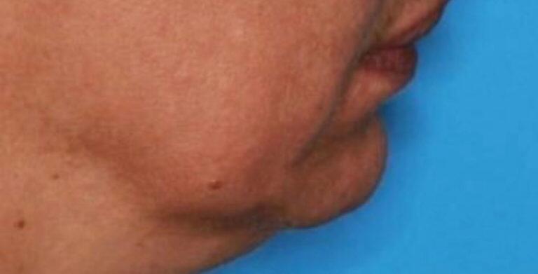 Chin Surgery Before & After Image